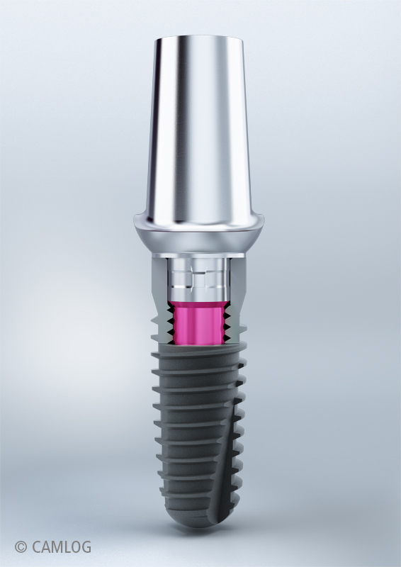 Praxis-Dr-Martin-Stengel-Leverkusen-Schlebusch-Zahnimplantate-Implantat