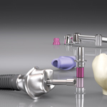 Implantologie Leverkusen-Schlebusch-Zahnimplantate-Dr. Martin Stengel